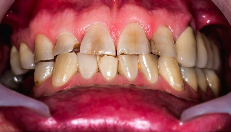 Full Mouth Reconstruction Before Hixson, TN