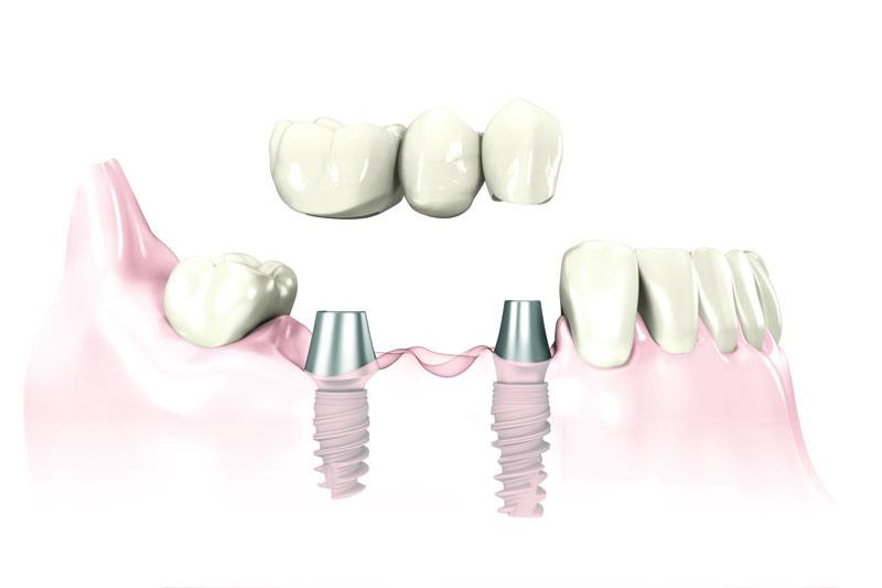 replace a few teeth with dental implants Hixson, TN