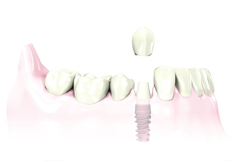 replace one tooth with dental implant Hixson, TN