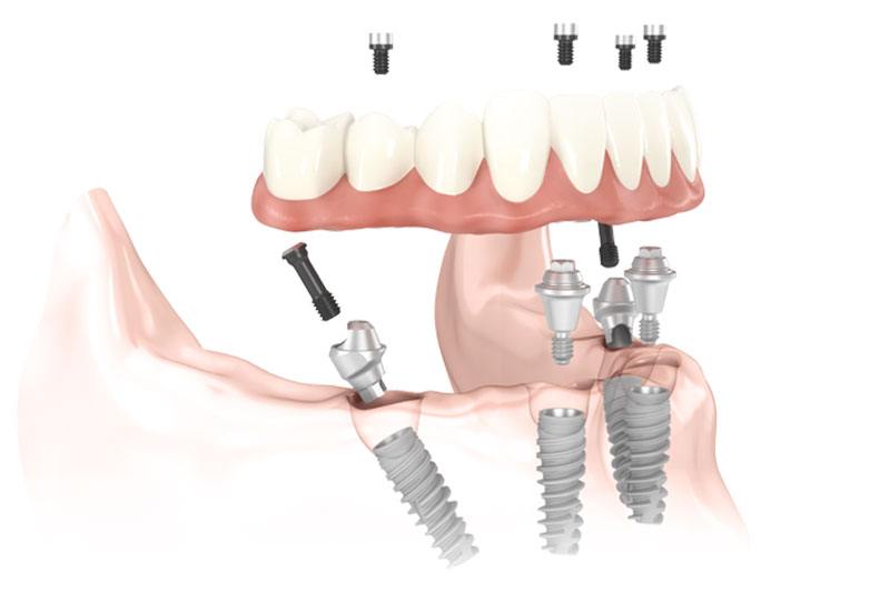 replace a full arch with dental implants Hixson, TN
