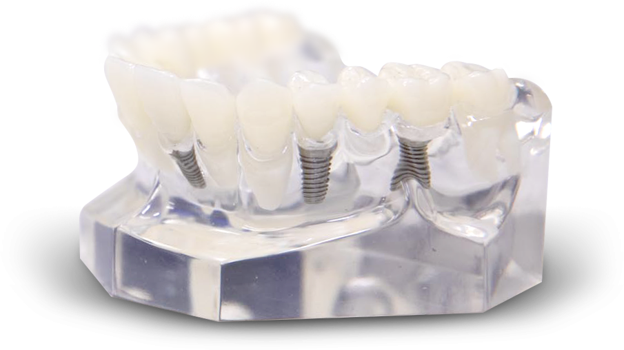 dental implants Hixson, TN