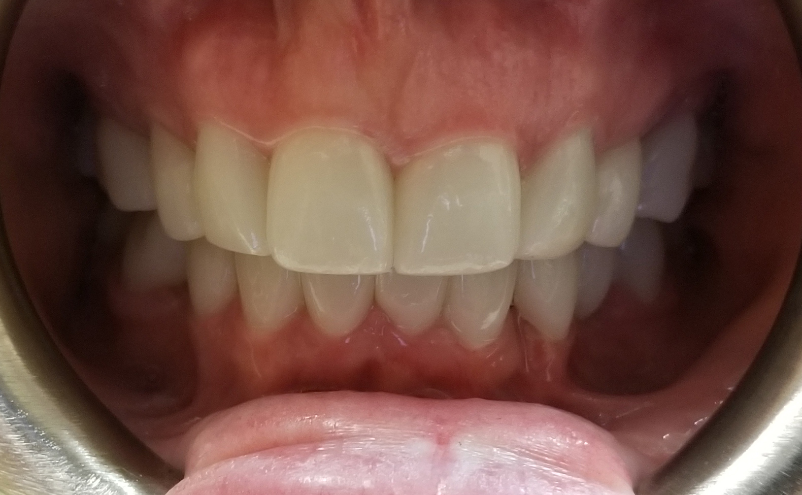 front teeth after full mouth reconstruction hixson tn