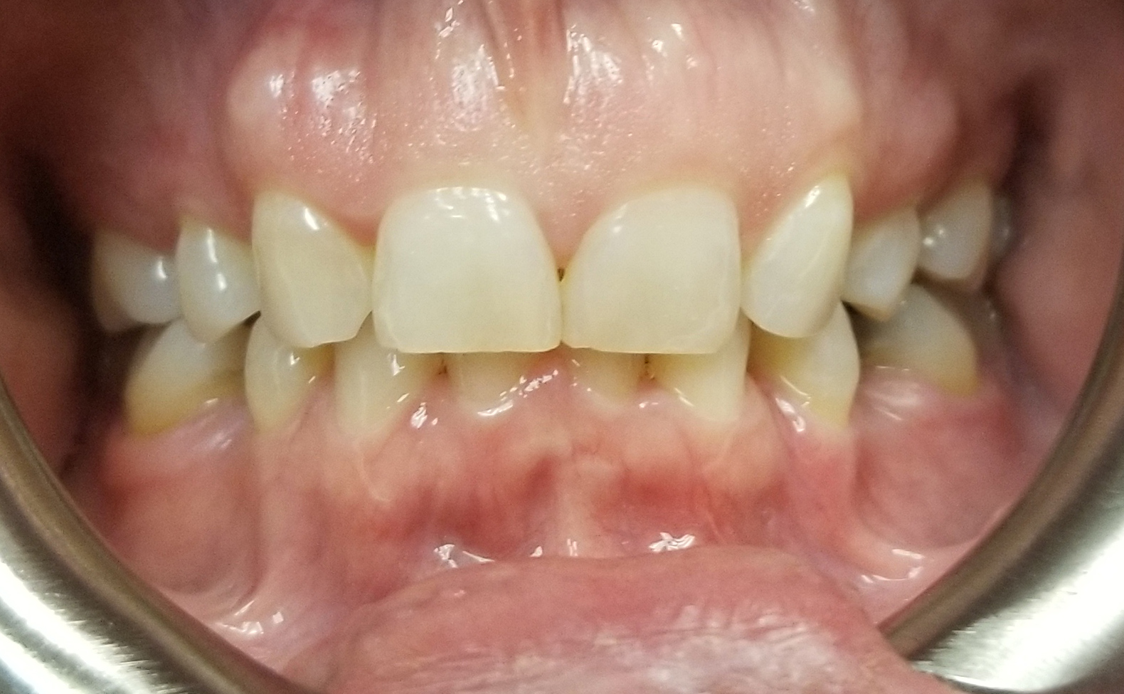 front teeth before full mouth reconstruction hixson tn